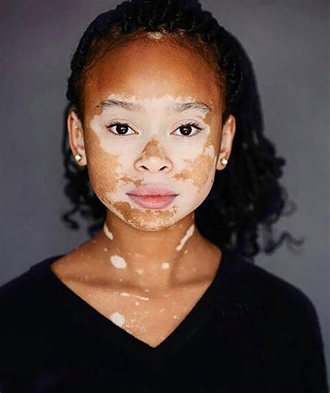 vitiligo fotos|Vitiligo Images